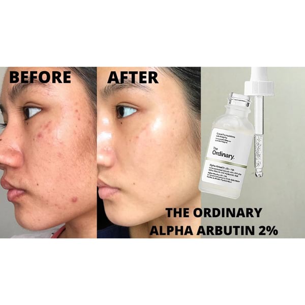The Ordinary Alpha Arbutin 2% + HA, 30 ml- For Skin Brightening 2 The Ordinary Alpha Arbutin 2% + HA, 30 ml- For Skin Brightening - Image 2