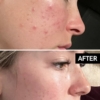 The Inkey List Beta Hydroxy Acid Serum, 30 ml 5 The Inkey List Beta Hydroxy Acid Serum 30 ml 1