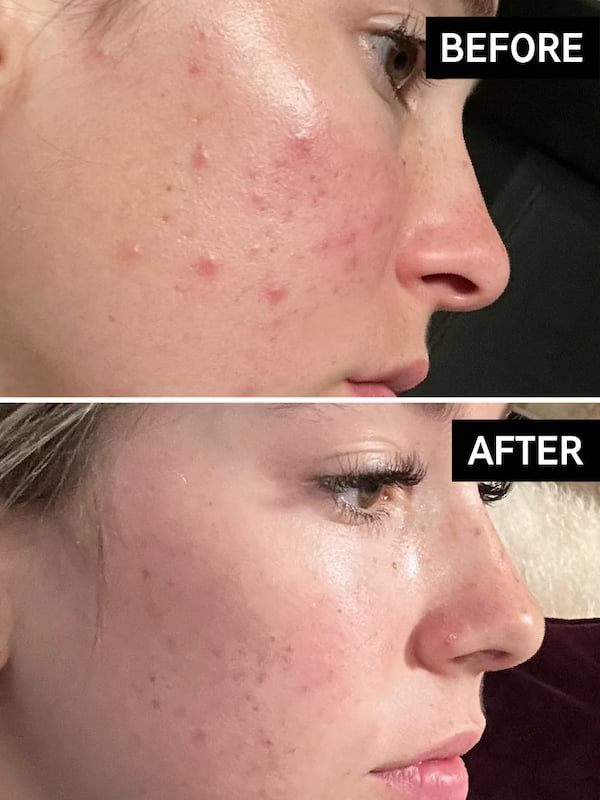 The Inkey List Beta Hydroxy Acid Serum, 30 ml 3 The Inkey List Beta Hydroxy Acid Serum, 30 ml - Image 3