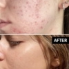 The Inkey List Beta Hydroxy Acid Serum, 30 ml 4 The Inkey List Beta Hydroxy Acid Serum 30 ml 3