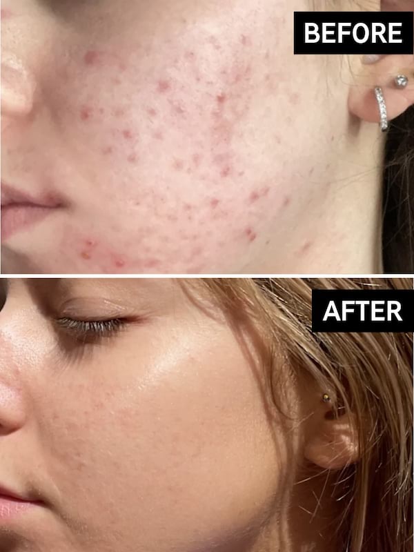 The Inkey List Beta Hydroxy Acid Serum, 30 ml 2 The Inkey List Beta Hydroxy Acid Serum, 30 ml - Image 2