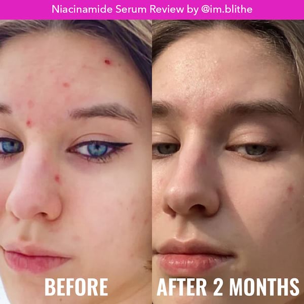 Good Molecules 10% Niacinamide Serum, 30 ml 3 Good Molecules 10% Niacinamide Serum, 30 ml - Image 3