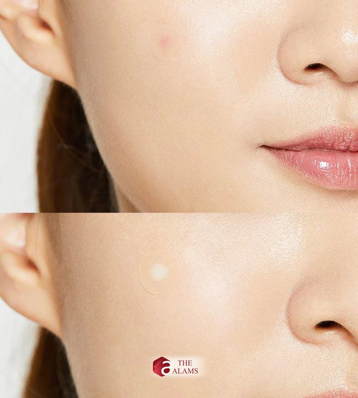 Cosrx Pimple Patch 4 Cosrx Pimple Patch - Image 4