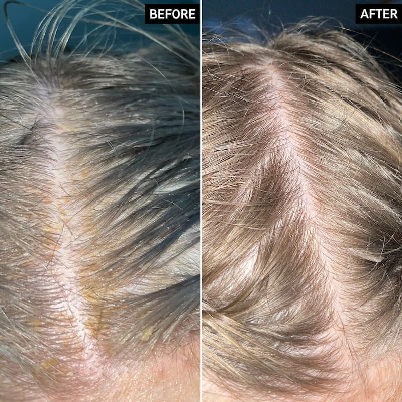 The Inkey List Salicylic Acid Exfoliating Scalp Treatment, 150 ml 3 The Inkey List Salicylic Acid Exfoliating Scalp Treatment, 150 ml - Image 3
