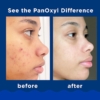 PanOxyl Acne Foaming Face And Body Wash With 10% Benzoyl Peroxide, 156 g 5 PanOxyl Acne Foaming Wash With 10% Benzoyl Peroxide Maximum Strength, 85 g