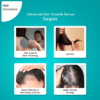 Pilgrim Redensyl And Anagain Advanced Hair Growth Serum, 50 ml 13 Pilgrim Redensyl And Anagain Advanced Hair Growth Serum 2
